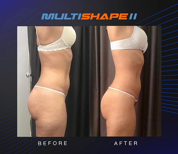 multishape cavitation rf ir lipo body contouring in tucson