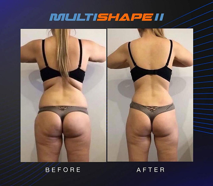 rf liposuction in tucson