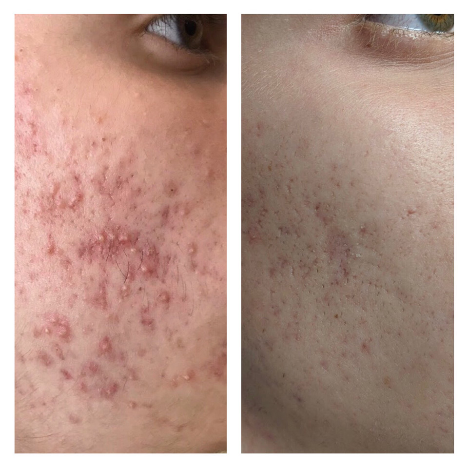 esosomes acne treatment tucson