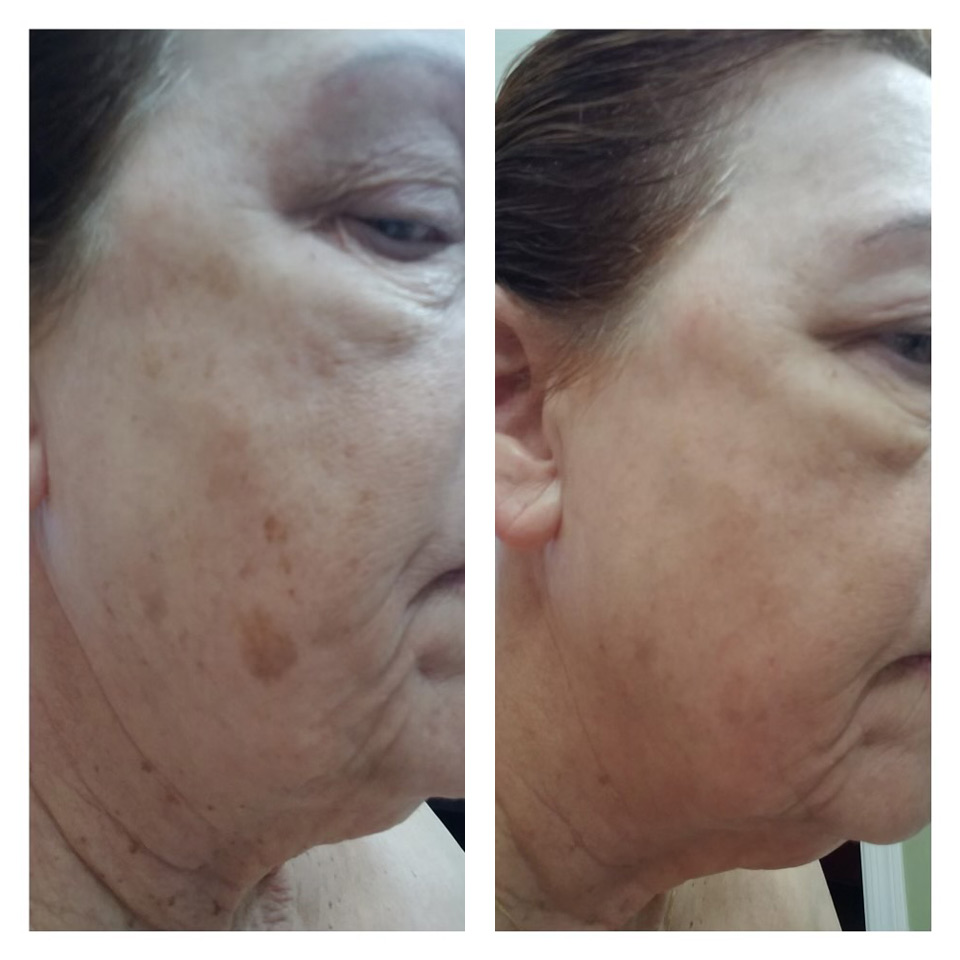 exosomes for hyperpigmentation in tucson