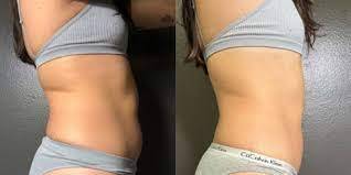 hydrodermabrasion in tucson